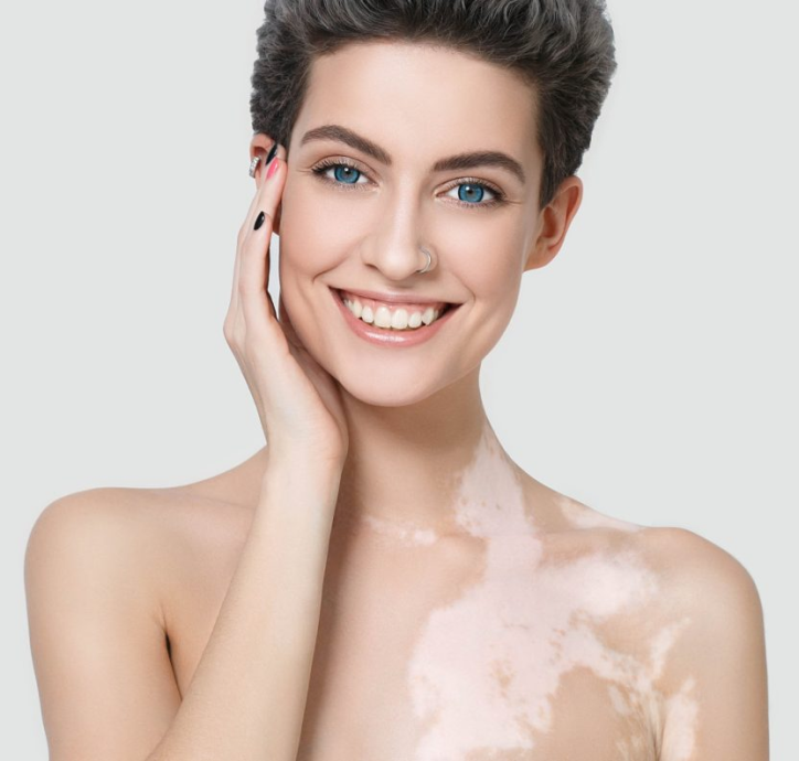 UVB Lamps for Vitiligo, UV Light Vitiligo Treatment NY, USA