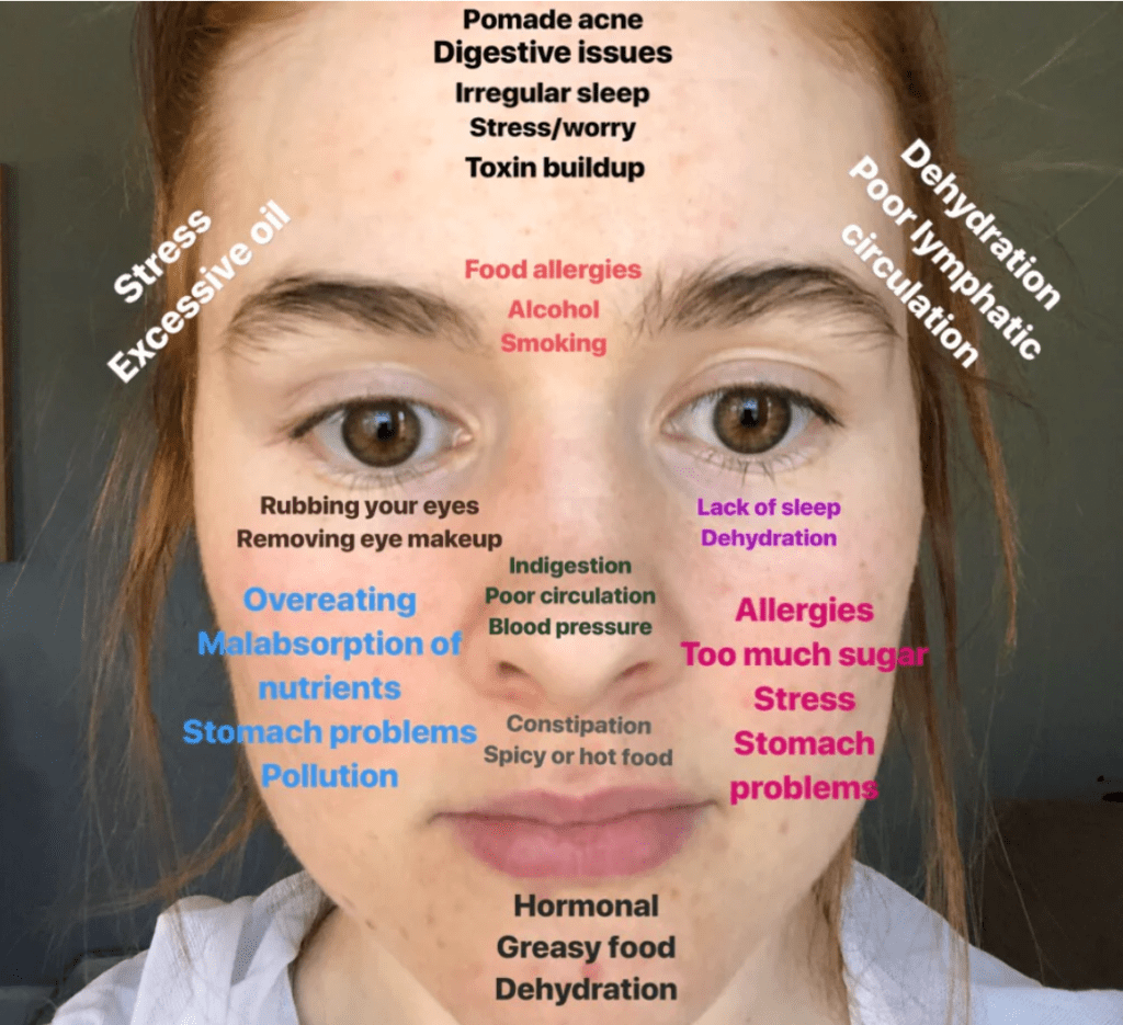 Understanding Cheek Acne Causes and Effective Treatments