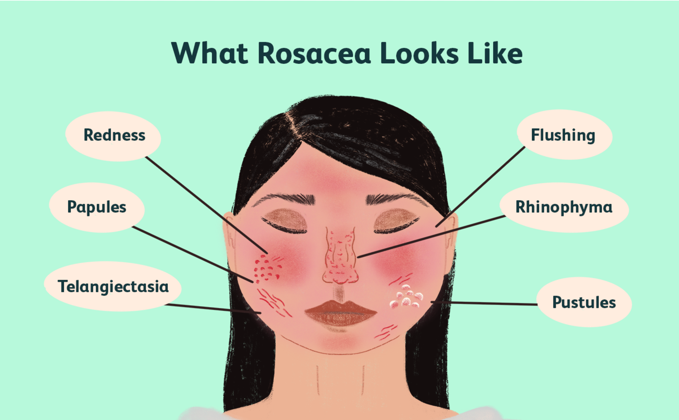 what rosacea look like