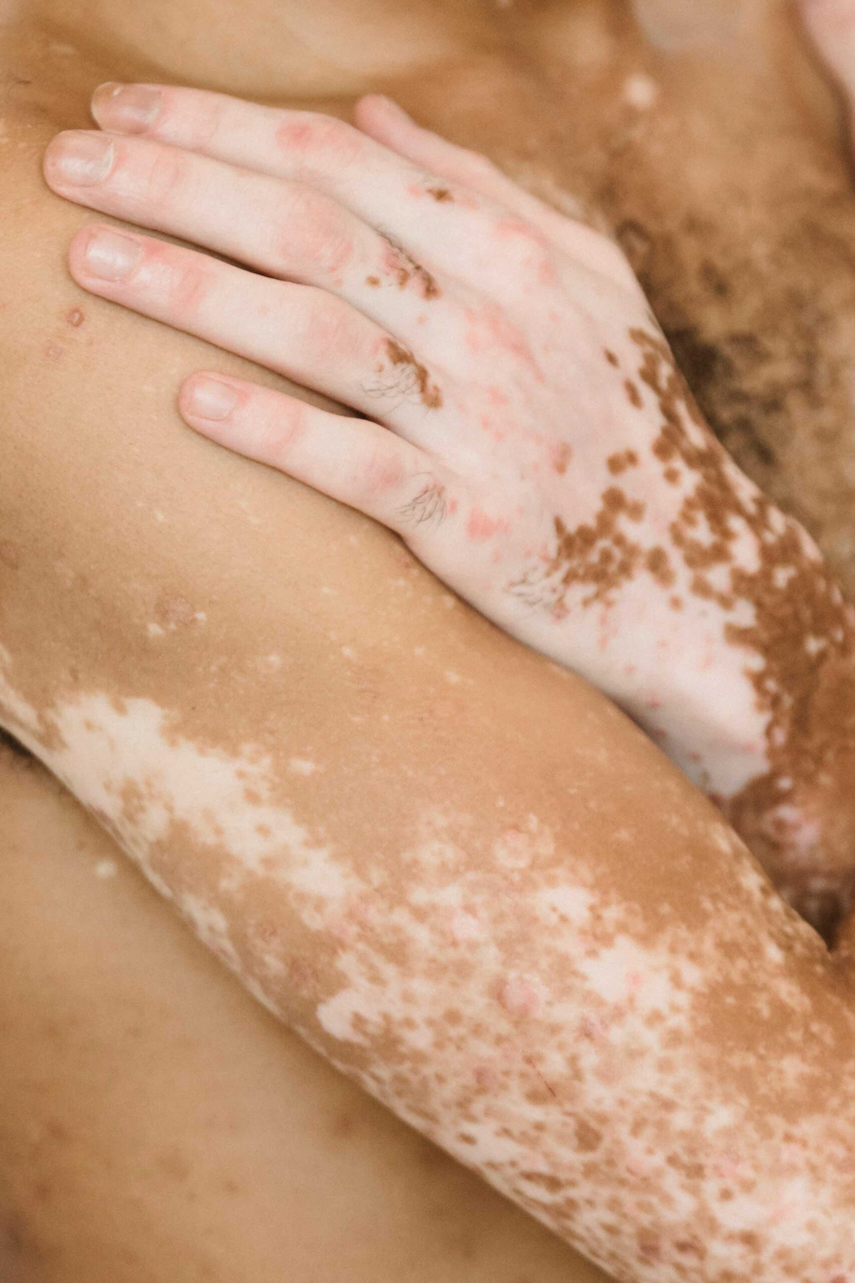 Understanding Vitiligo: Causes, Symptoms