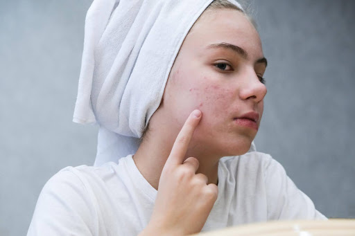 cystic acne treatment