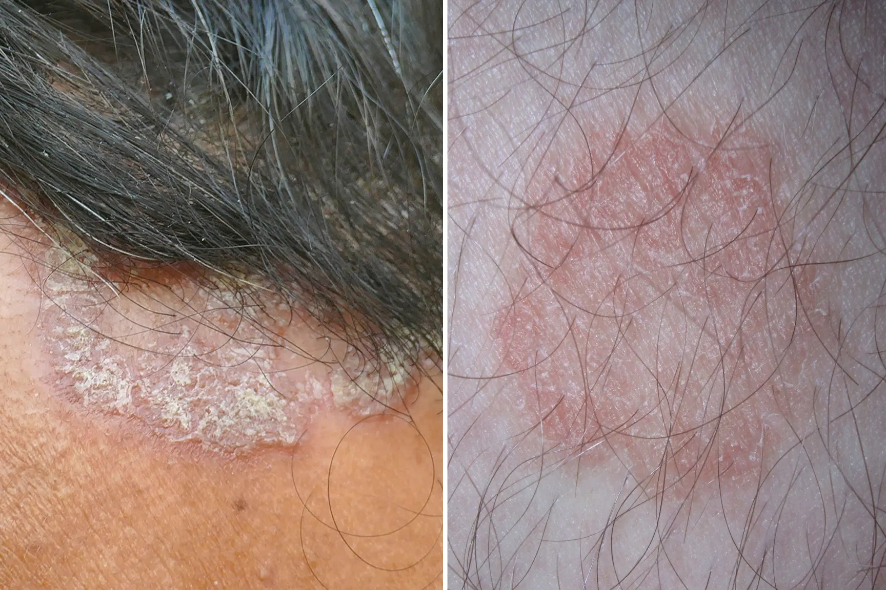 Two photos of scalp psoriasis (left), and a closeup of ringworm (right). GettyImages/anand purohit (left), Wikimedia Commons/James Heilman, MD, CC BY-SA 3.0 (right) 