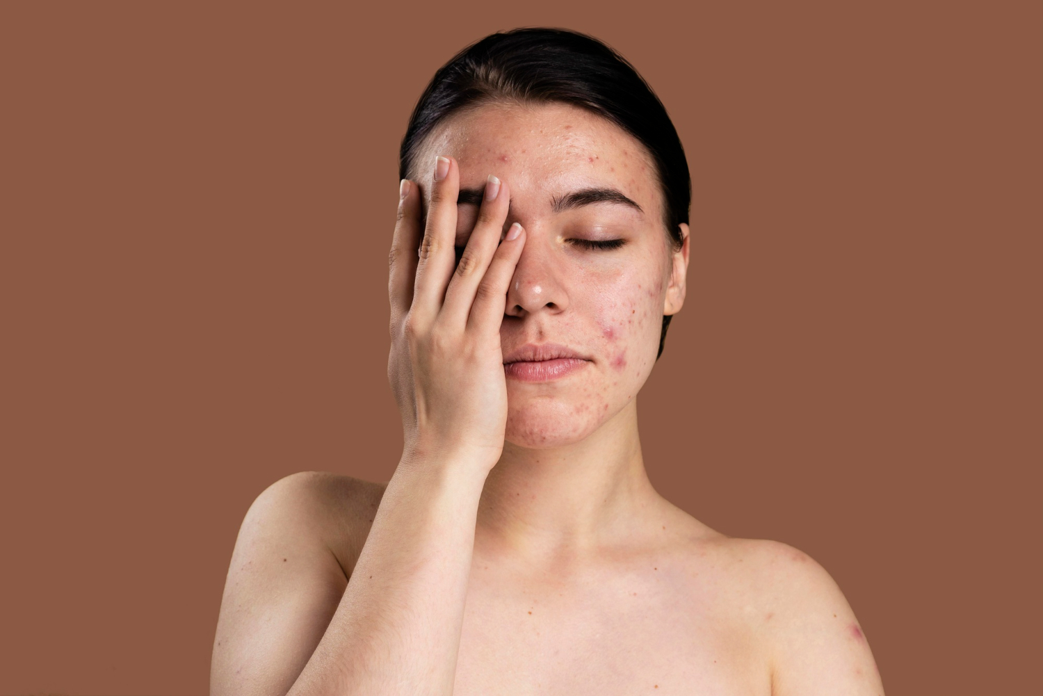 What Causes Forehead Acne? (And How To Get Rid Of It)