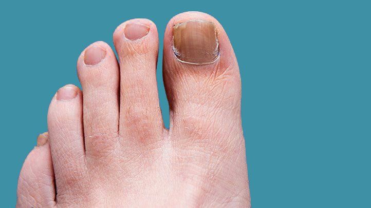 How to Treat Toenail Fungus With UV Light 