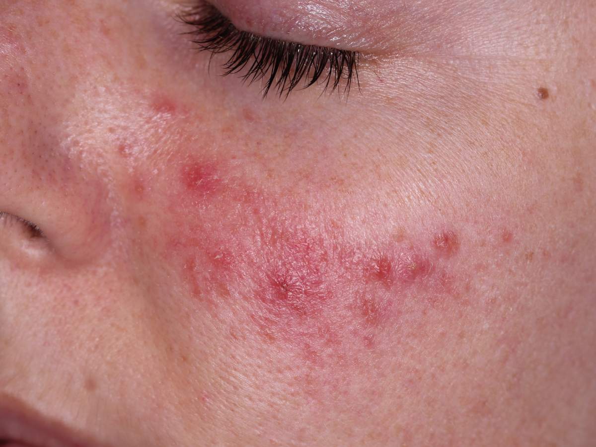 Rosacea: Symptoms, Causes, and Treatments