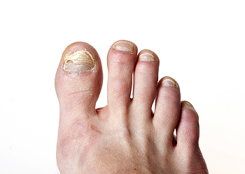 Toenail fungus, or onychomycosis, is a fungal infection of the nail. 