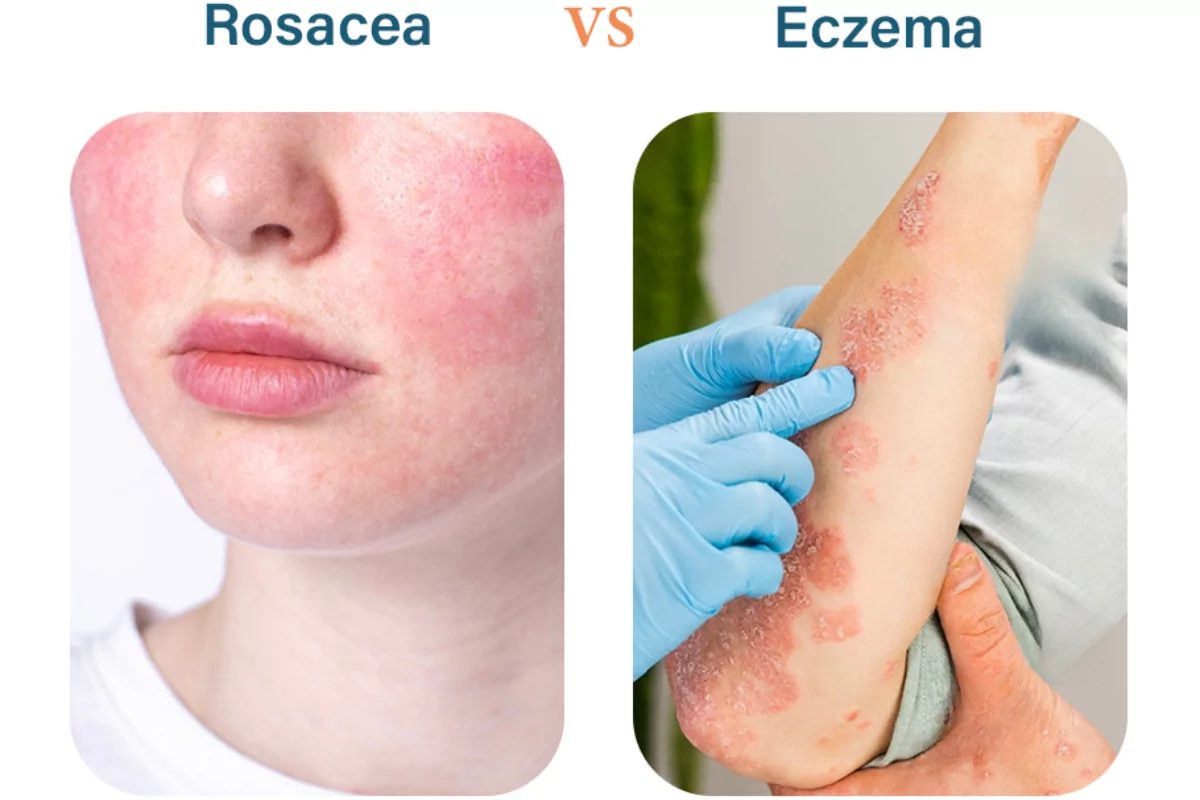 Understanding the Difference Between Rosacea and Eczema