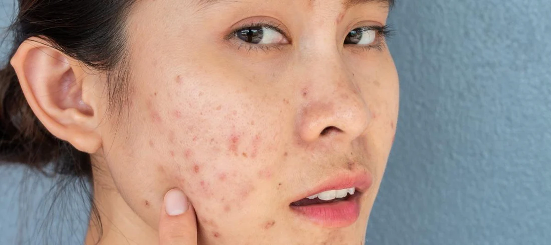 PIE and PIH Acne Marks