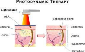 Understanding Photodynamic Therapy (PDT) & Blue Light for Actinic Keratosis and Other Skin Conditions