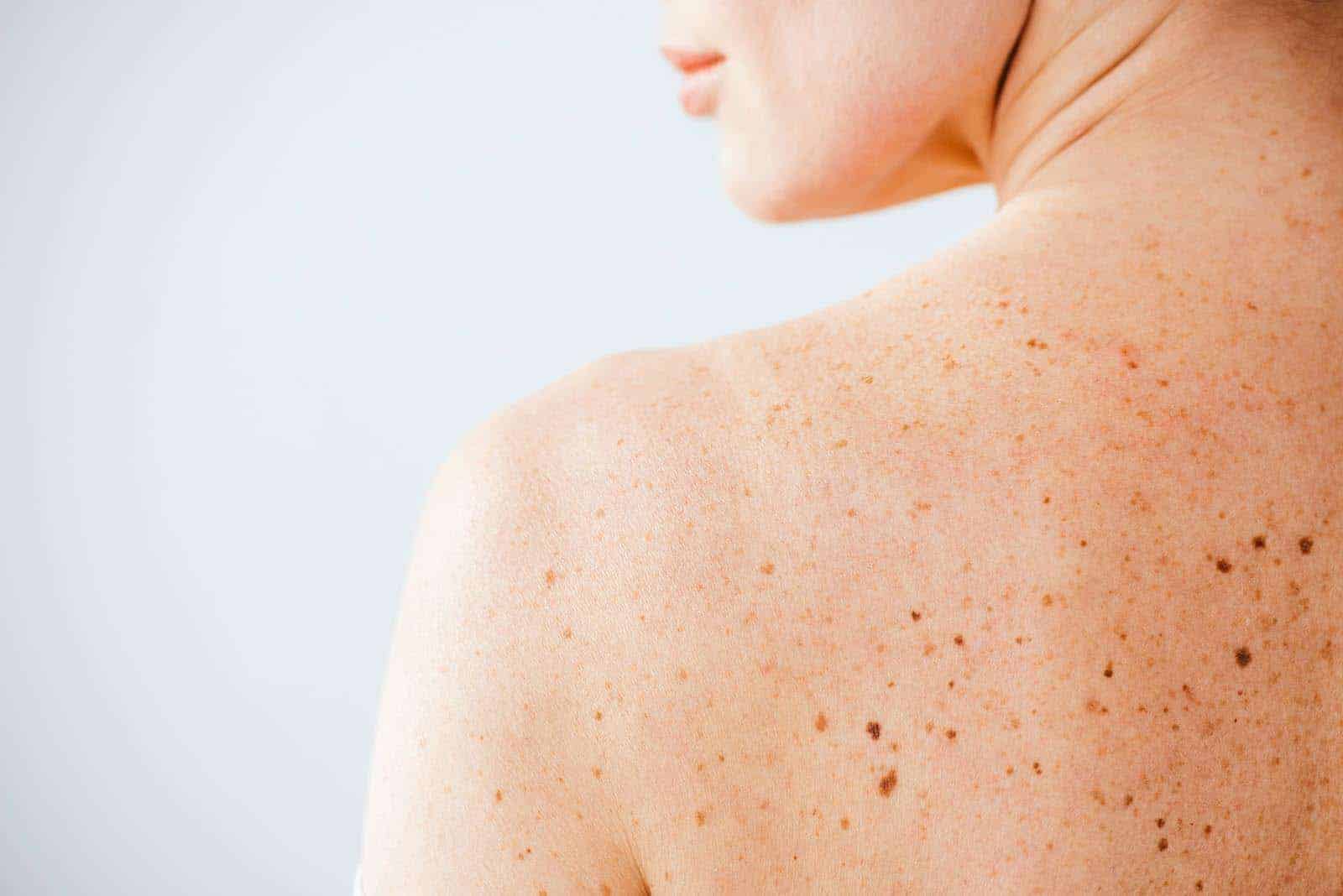 What’s the Difference Between Seborrheic Keratosis and Actinic Keratosis?