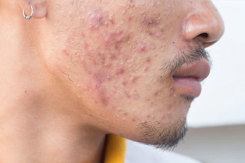 Do Acne Scars Go Away?