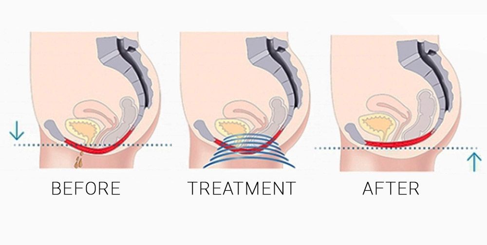 How Does Pelvic Floor Chair It Work?